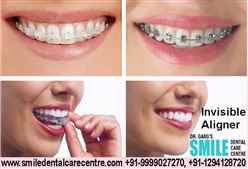 Best Invisible Clear Aligner and Brace Treatment in Faridabad