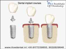 Dental Implantology courses in India at Ace Dental
