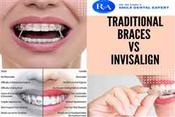 Best Invisible Aligner Treatment in India At SRG Hospital