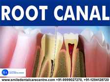 Painless Root Canal Treatment in Faridabad Near Me	