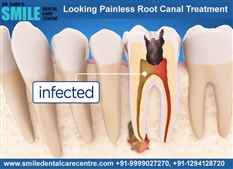 Painless Root Canal Treatments in Faridabad Location