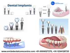 Best Dental Implant Clinics in Faridabad Delhi NCR