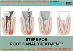 Where Can I Get Best Painless Root Canal Treatment in Faridabad