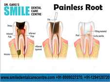 Painless Root Canal Treatment in India