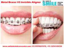 Best Invisible Aligner Treatment in Faridabad Experienced Orthodontist