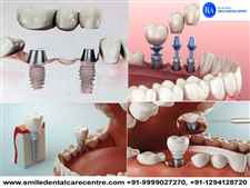 Best Dental Implant Clinic in Faridabad Delhi NCR