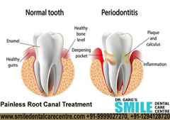 Painless Root Canal Treatments in Faridabad India