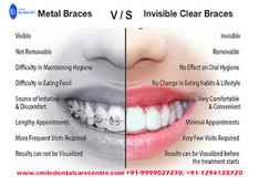 Best Invisible Aligner Treatment Orthodontic Treatments