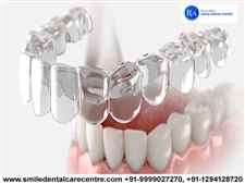 Best Invisible Aligner Treatment By Certified Orthodontist