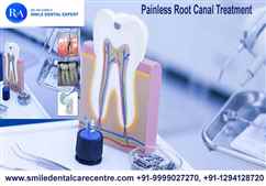 Best Dental Clinic For Painless Root Canal Treatment in Faridabad