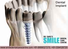 Best Dental Implant in Faridabad Location India