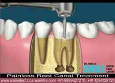 Visit For Painless Root Canal Treatment in Faridabad