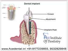 Dental implant courses in India Ace Institute of Dentistry