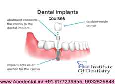 Dental Implant or Implantology Courses In India