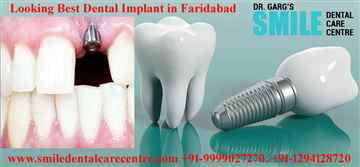 Best Dental Implant Treatments in Faridabad India 