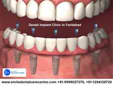 Best Dental Implant Clinics in Faridabad Smile Dental