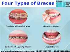 Dental Braces Treatment in Faridabad Traditional Dental Braces Treatment