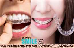 Best Invisible Aligner Treatments Available in Faridabad