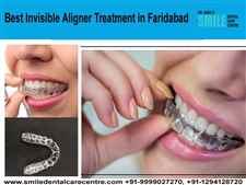 Best Invisible Aligner Treatment At Affordable Cost in Faridabad