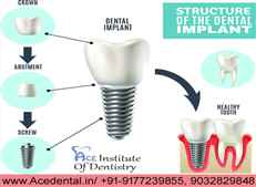 Dental Implants Courses in India