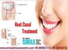 Painless Root Canal Treatment At Smile Dental