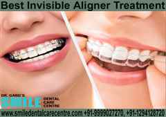 Looking For Invisible Aligner Treatment in Faridabad